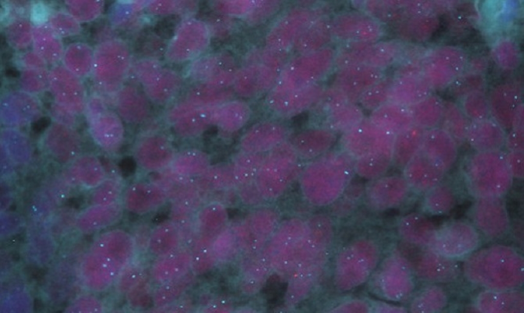 Avances en cáncer de próstata