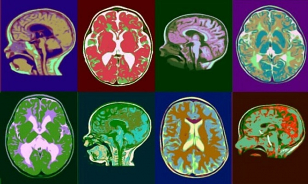 Identifican el gen PI4KA como causante de una nueva enfermedad neurológica