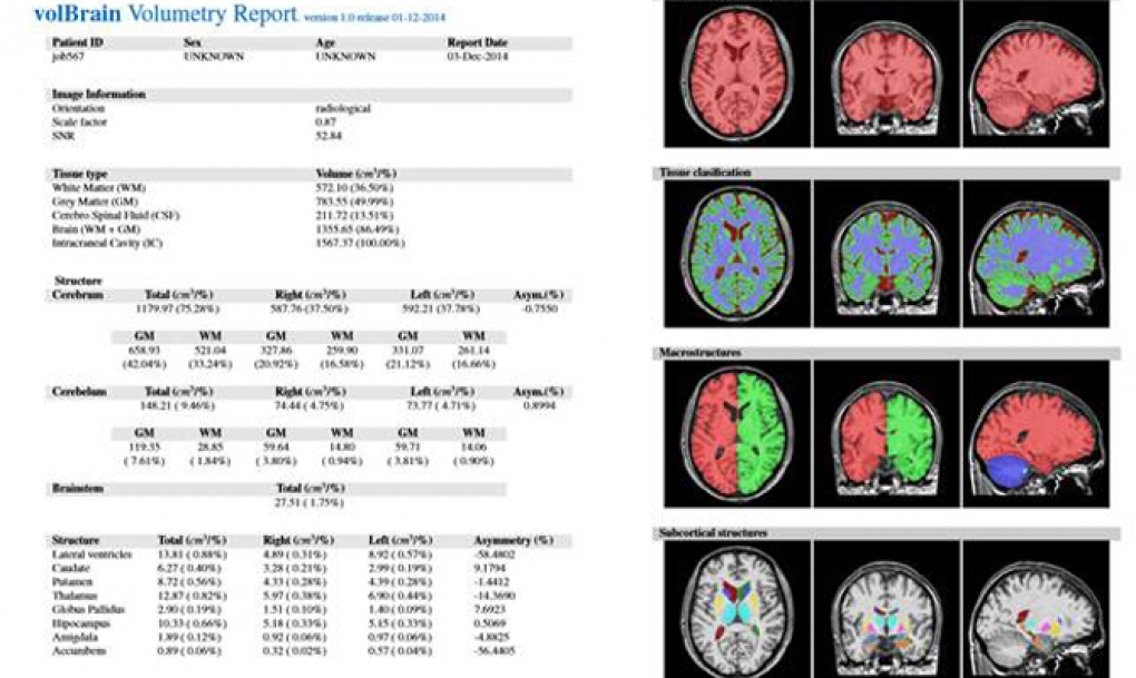 Un sistema &#8216;on line&#8217; y gratuito de análisis de imágenes de resonancia magnética del cerebro