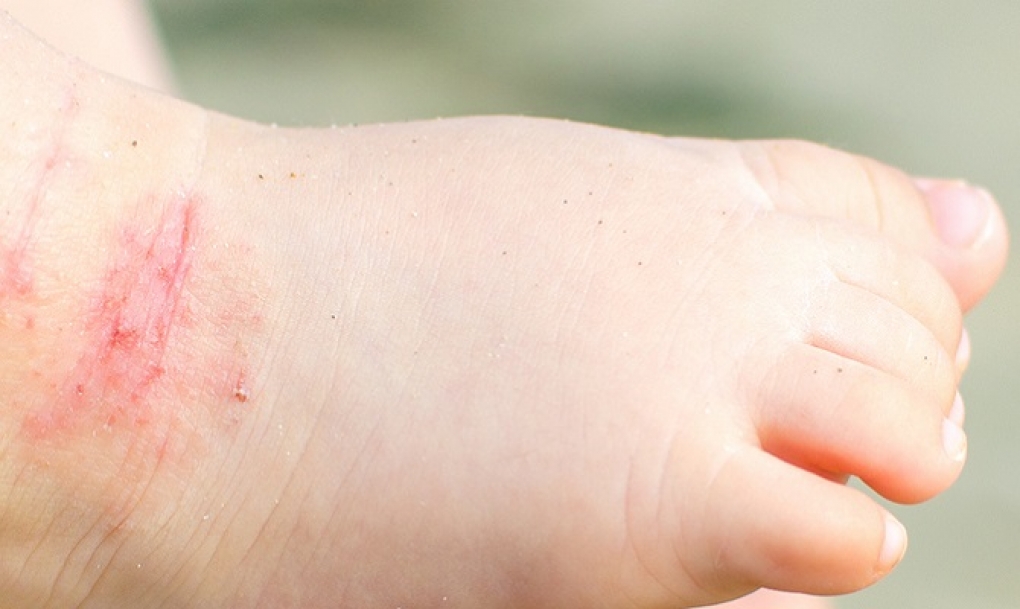 La campaña &#8216;Vivir Sin Vivir&#8217; refleja la realidad más desconocida de la dermatitis atópica