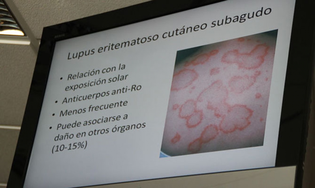 La prevalencia del lupus ha aumentado en la población española durante ...
