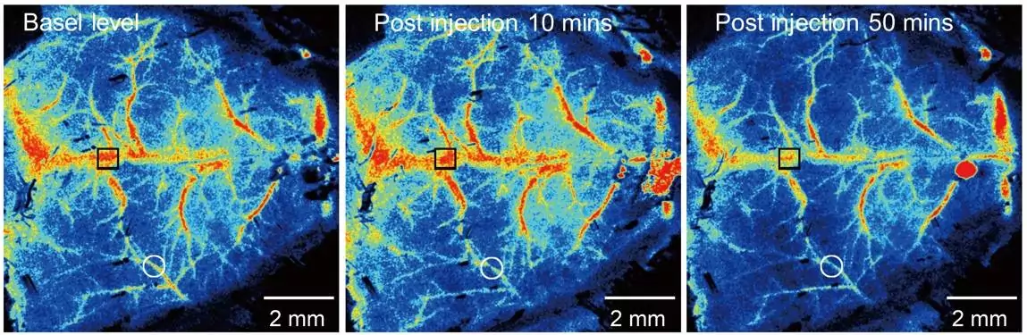 Los microplásticos pueden causar trombos en el cerebro
